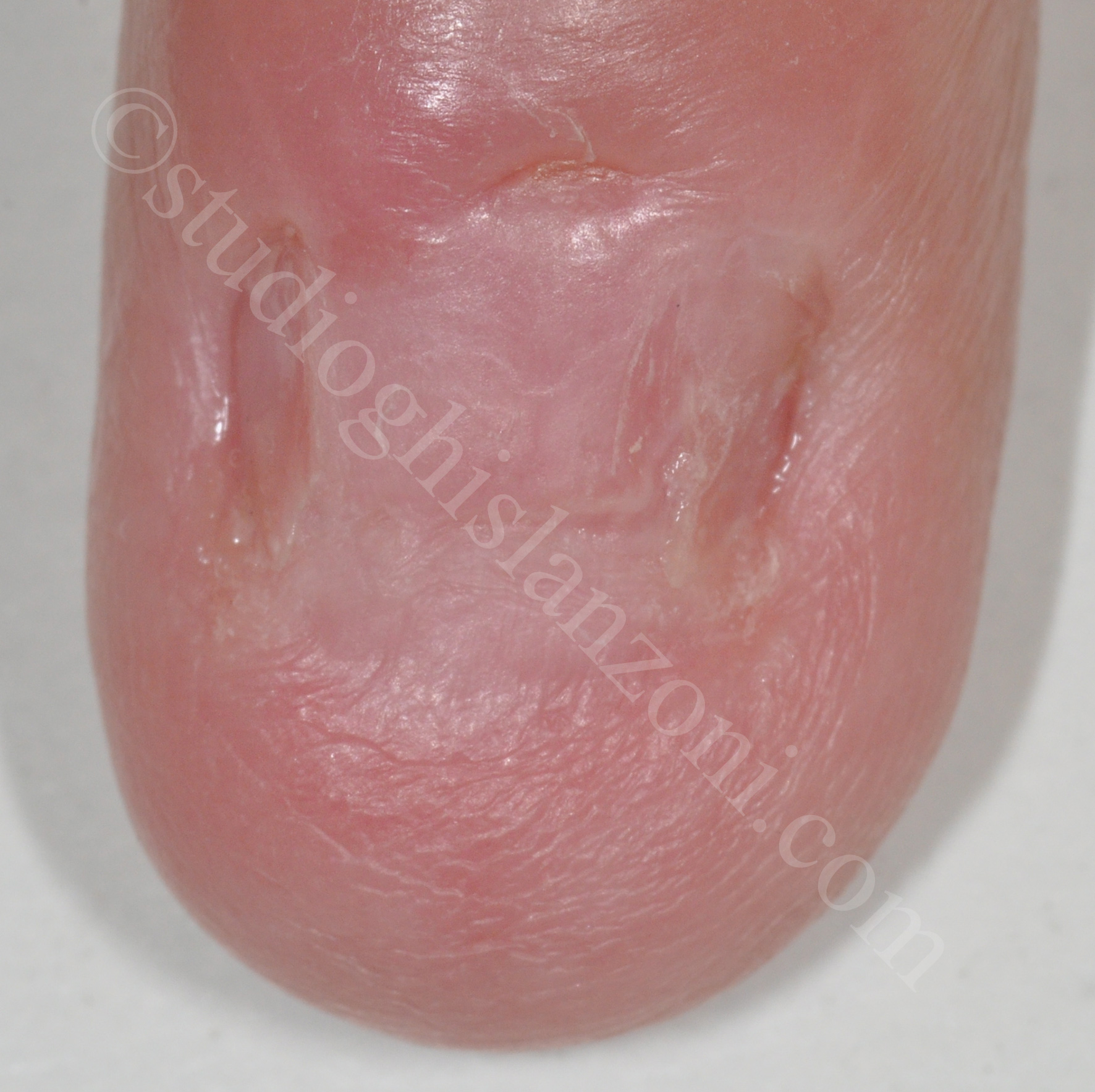 Anonichia