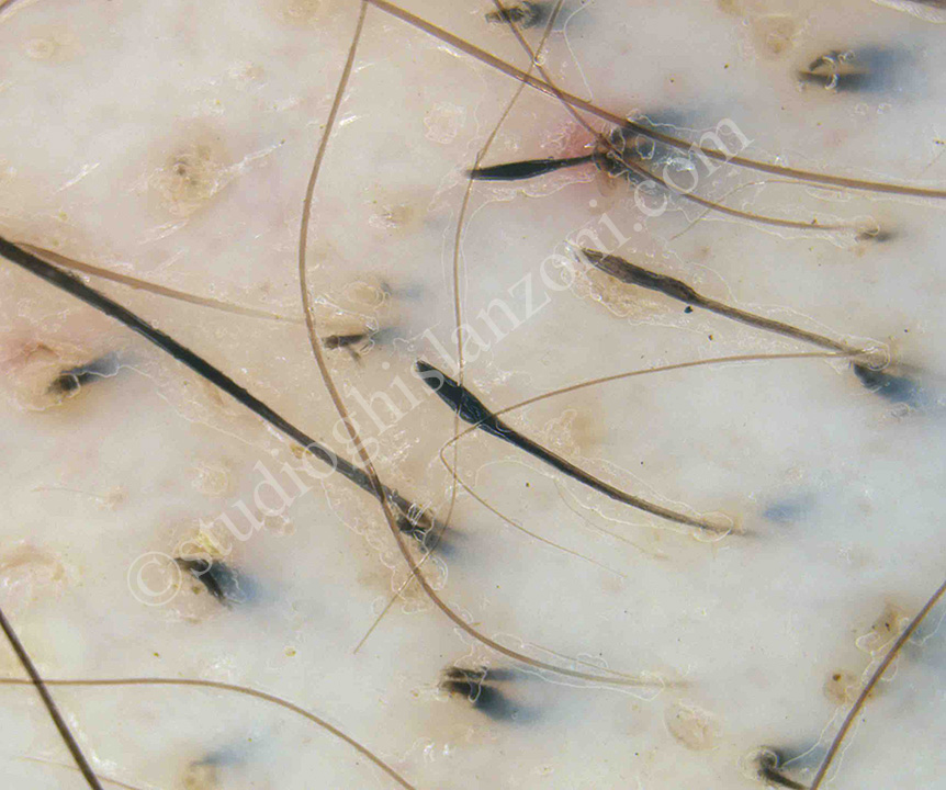 Capelli-a-punto-esclamativo-nellAlopecia-areata.jpg