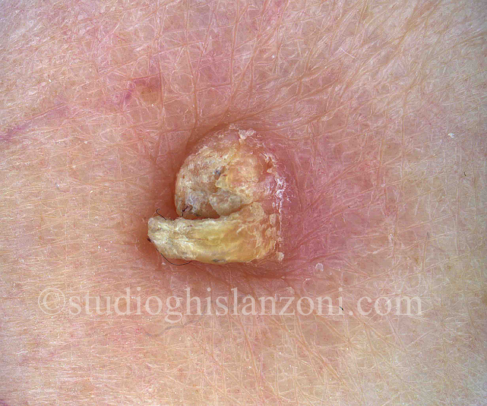Carcinoma_Spinocellulare_della_gamba.jpg