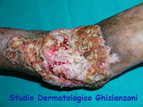 Carcinoma spinocellulare arto sup