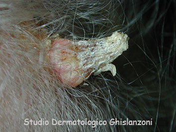 Carcinoma spinocellulare del capillizio