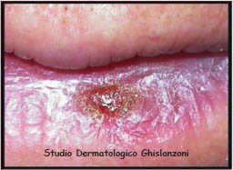 Cheilite_attinica.jpg