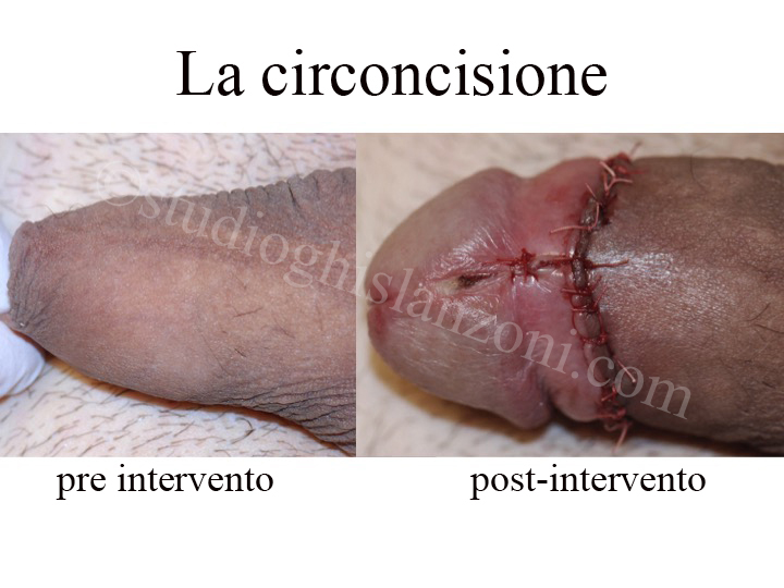 Differenza tra pene circonciso e pene non circonciso