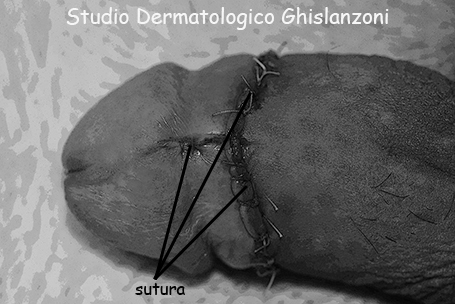 Il pene dopo la circoncisione