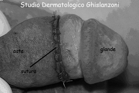 Il pene dopo la circoncisione