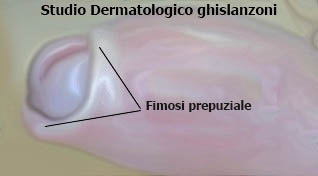 Circoncisione_da_Fimosi.jpg