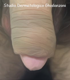 Circoncisione parziale