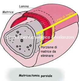 Cura dellunghia incarnita