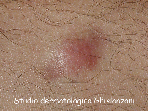 Dermatofibrosarcoma protuberans.jpg