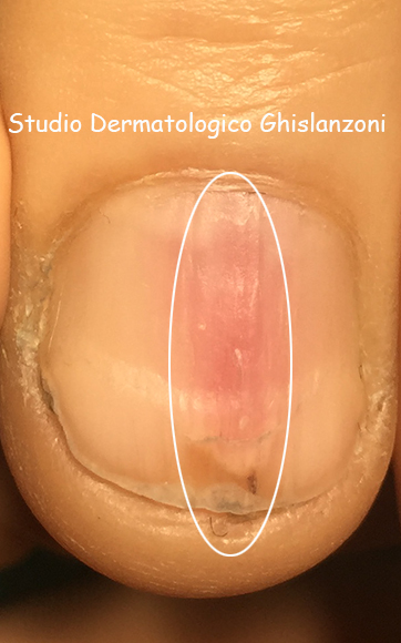 Eritronichia post traumatica
