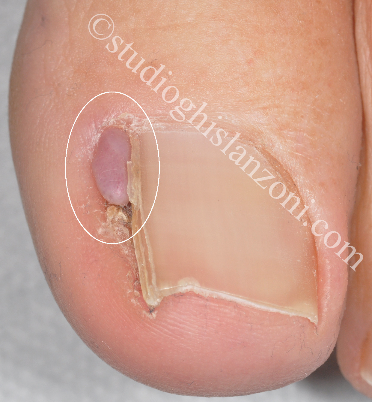 Fibrocheratoma digitale acquisito