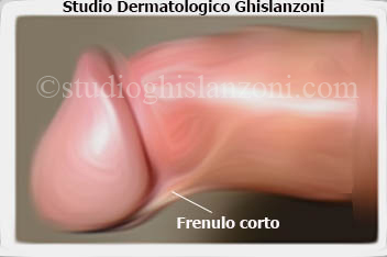 Frenulo_corto.jpg