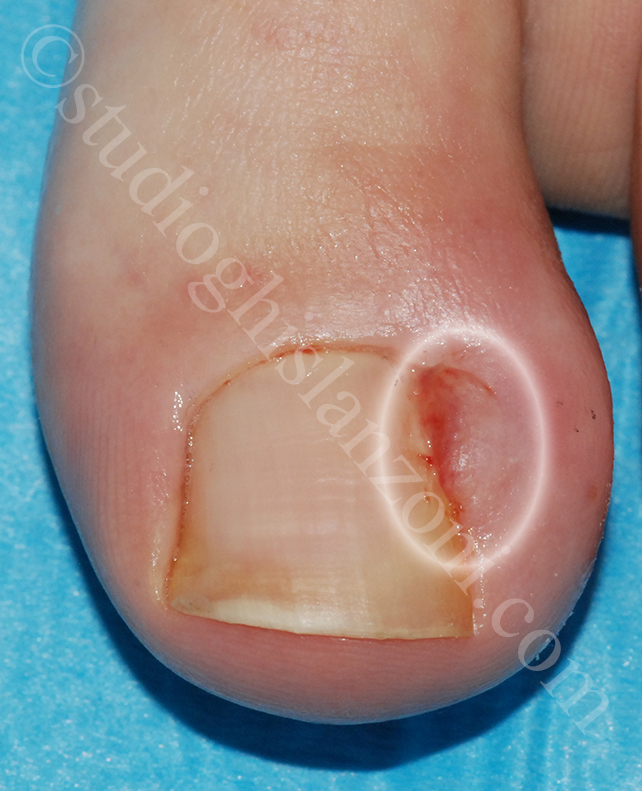 Il Granuloma periungueale