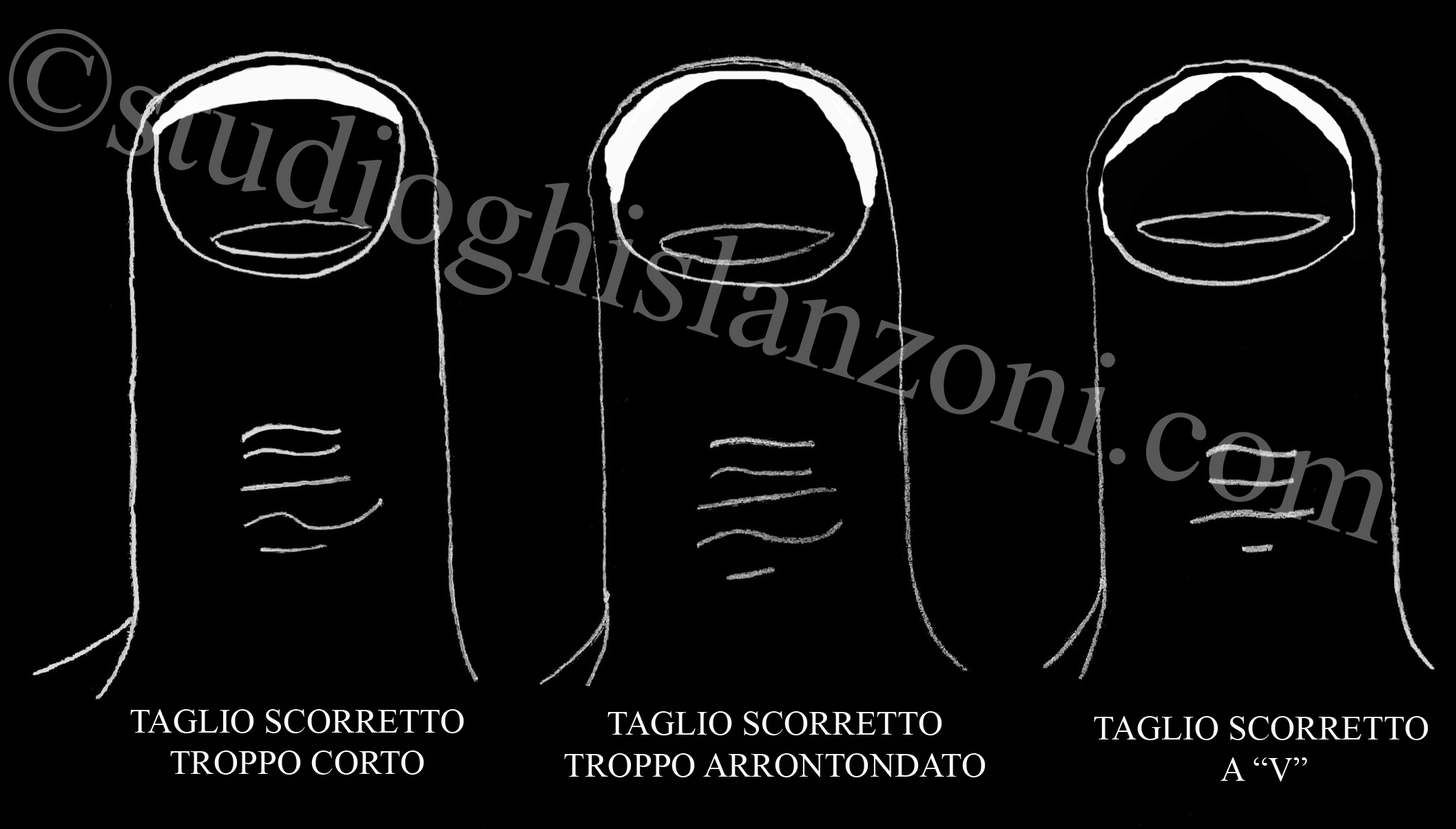 Il Taglio scorretto delle unghie