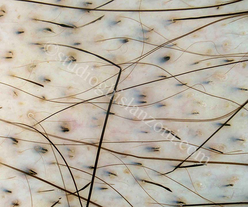 LEsame-Tricologico-nellAlopecia-Areata.jpg