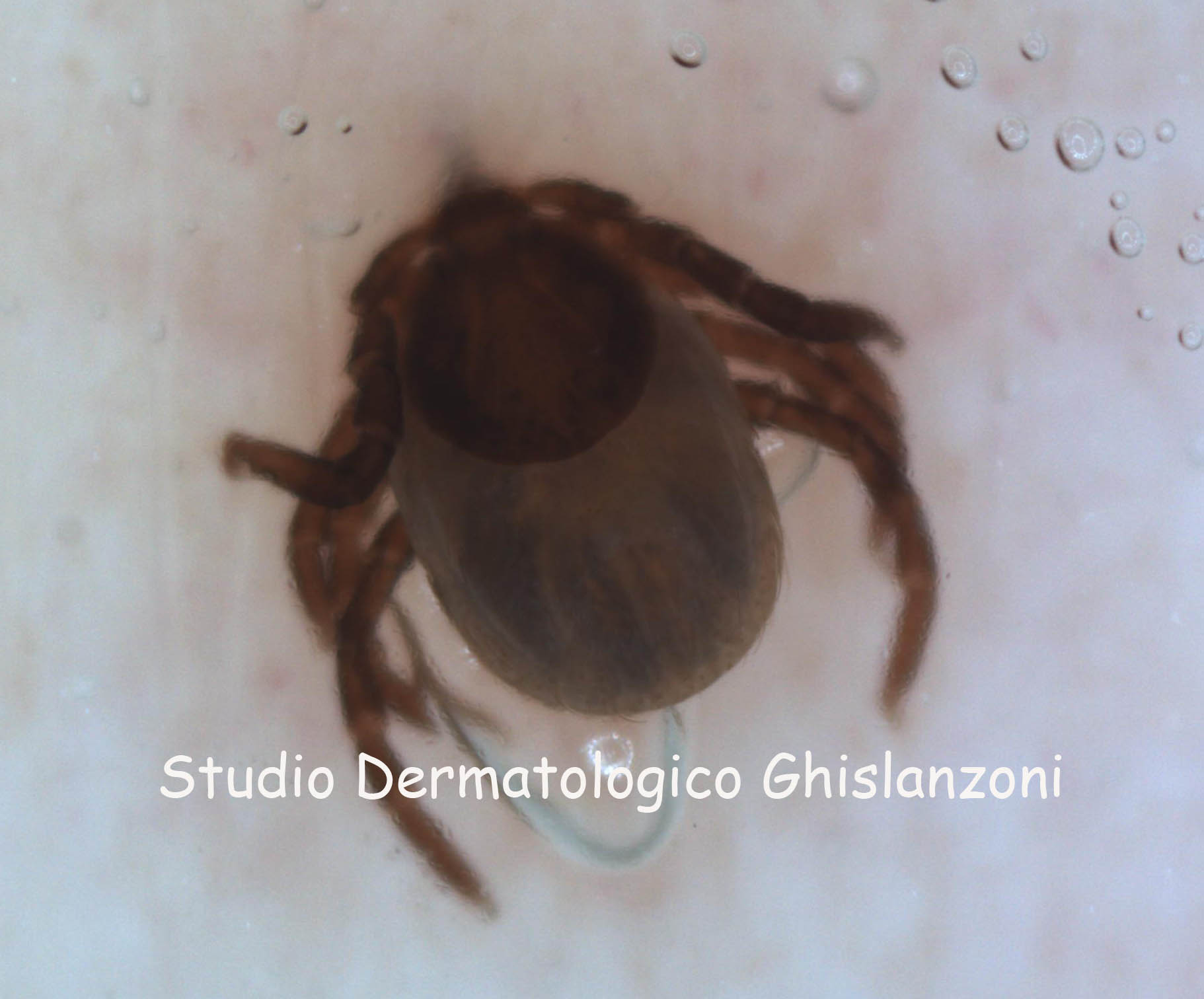 La puntura della zecca