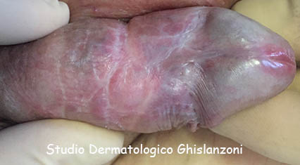 Lichen_sclero_atrofico.jpg