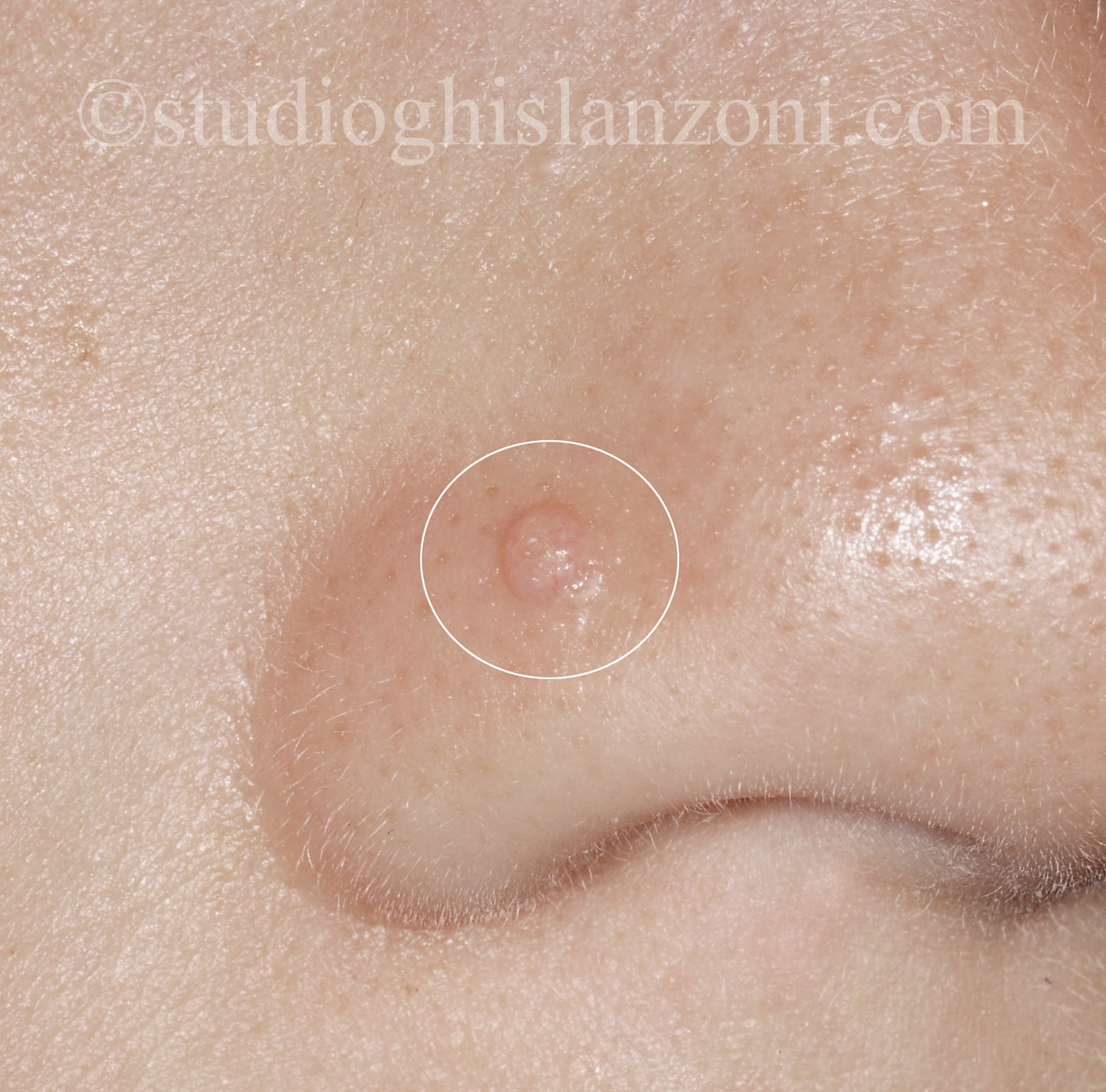 Mollusco contagioso nel bambino