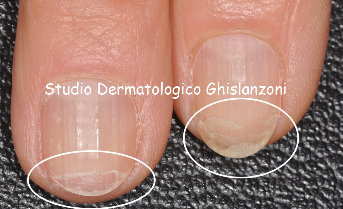 ONICOSCHIZIA.JPG