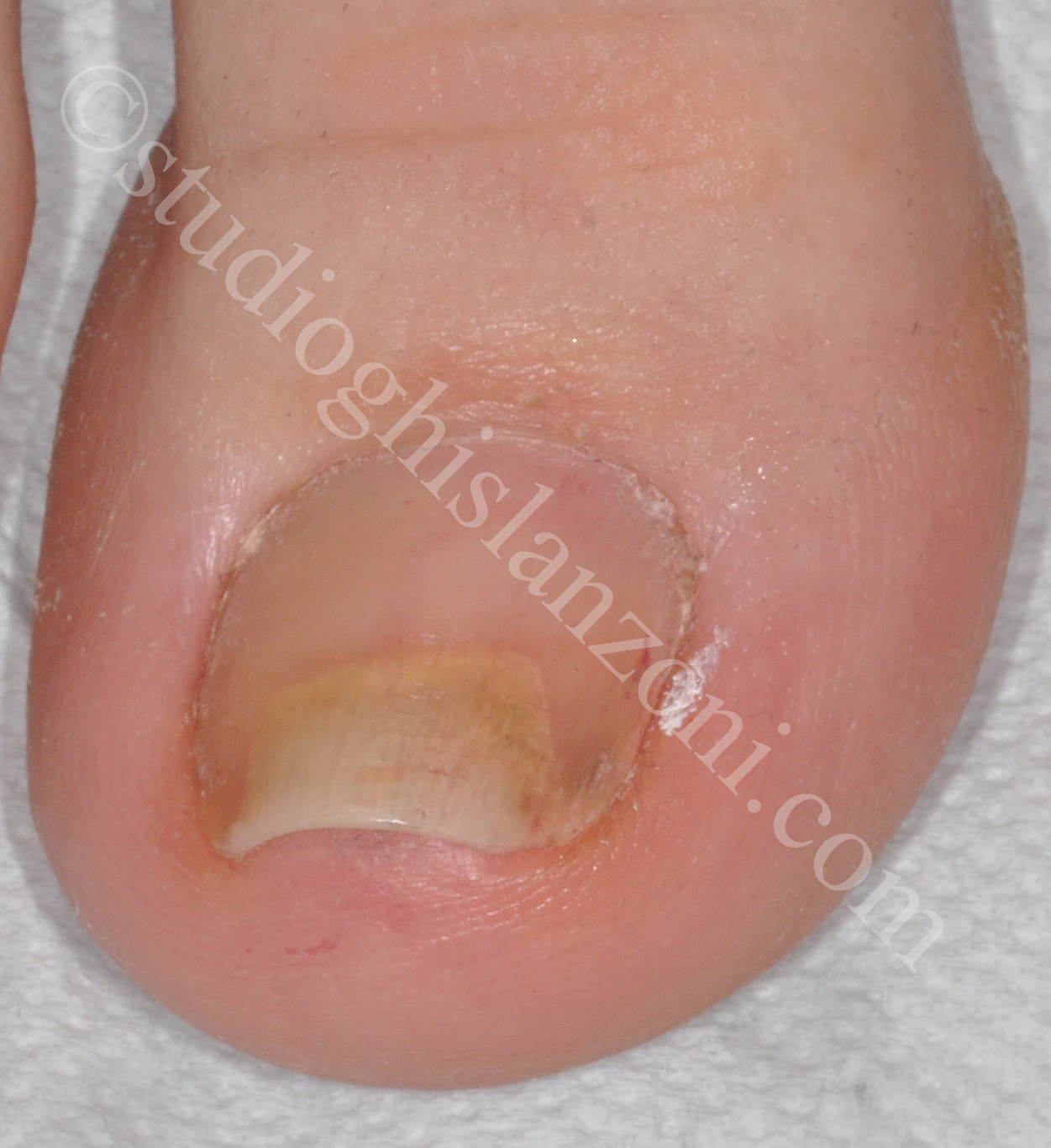 Onicolisi da pedicure