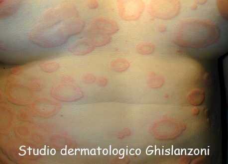 Orticaria.jpg