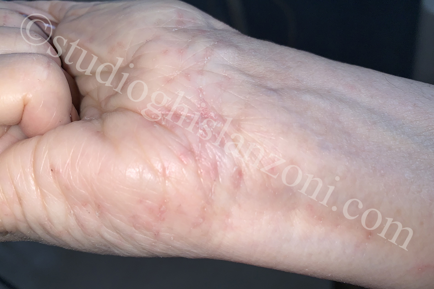 Scabbia_Mani.jpg