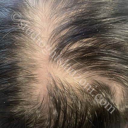 Telogen-effluvium.jpg