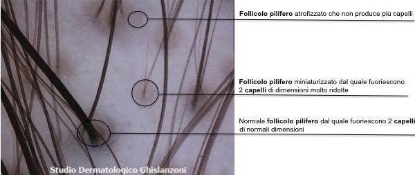alopecia androgenetica calvizie