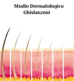 alopecia androgenetica