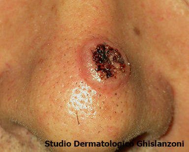 cheratoacantoma