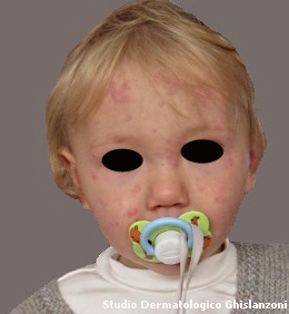 dermatologia allergologica