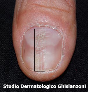 distrofia mediana canaliforme