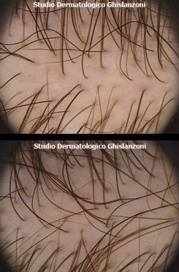 finasteride.jpg