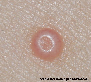 Foto ingrandita di un mollusco contagioso