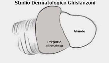 parafimosi