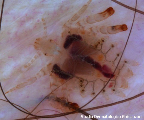 Foto piattola del pube ingrandita