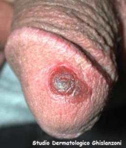 sifiloma