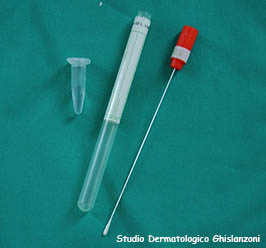 Malattie veneree: foto tampone uretrale