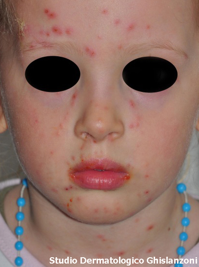 varicella