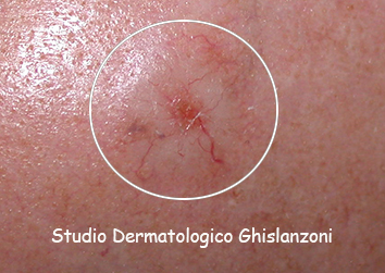 basalioma_sclerodermiforme.jpg