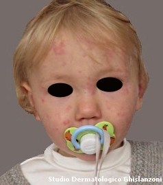 Orticaria_nel_bambino.jpg