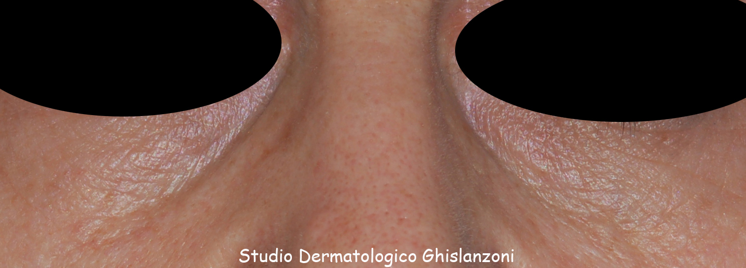 Filler Canale Lacrimale 1.jpg