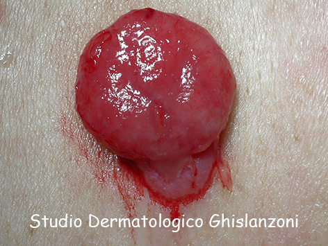 Melanoma_amelanotico.jpg