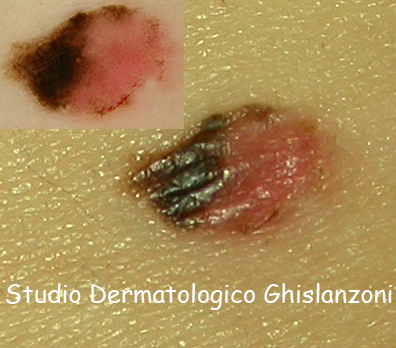 Melanoma del bambino
