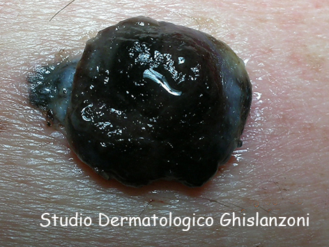 Melanoma_nodulare.jpg