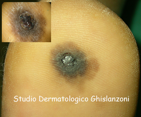 Melanoma_plantare.jpg