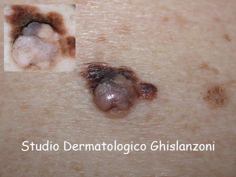 Melanoma_su_nevo.jpg