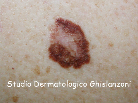 Melanoma_superficiale.jpg