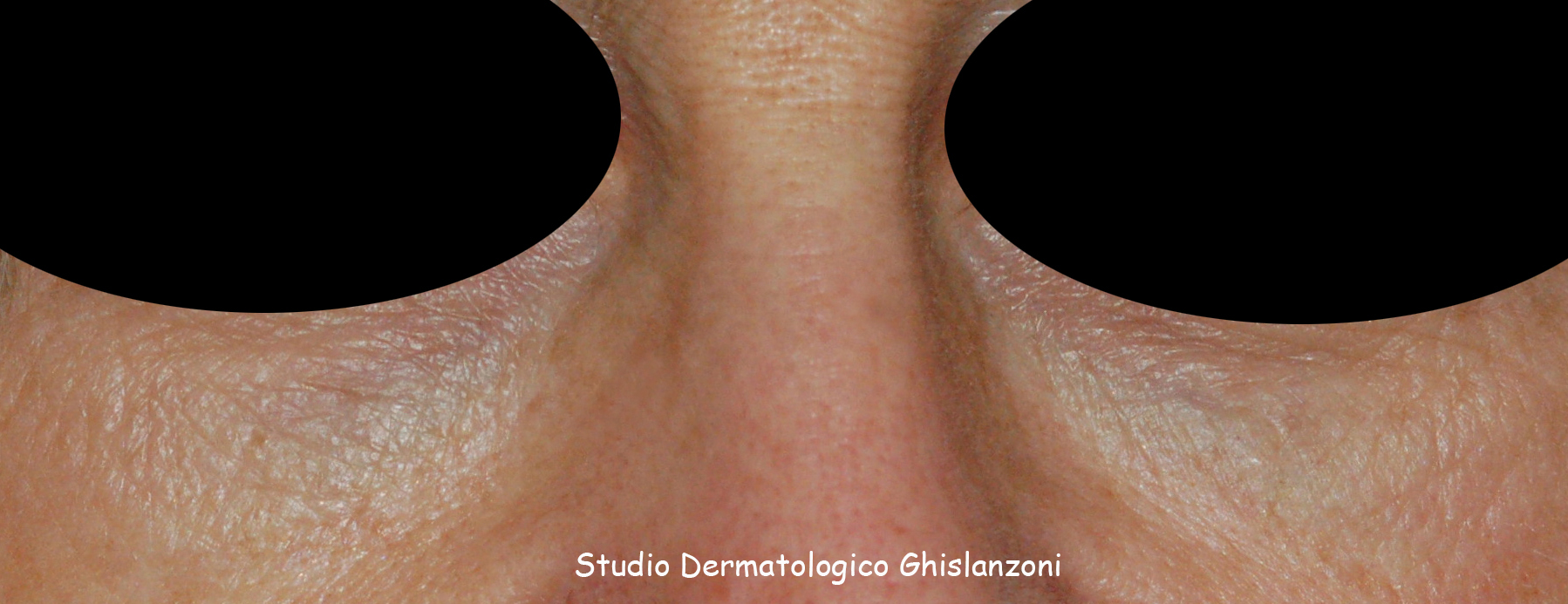filler Canale Lacrimale 2.jpg