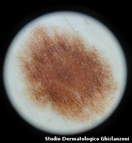 melanoma